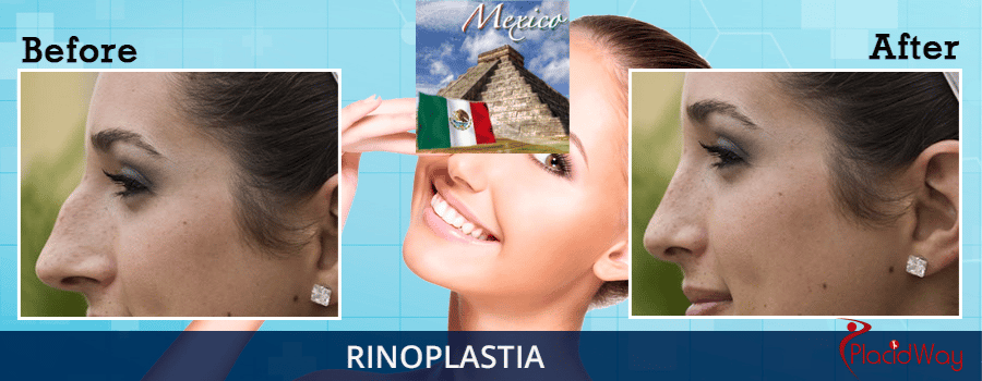 Nose Job Surgery Before and After in Tijuana, Mexico